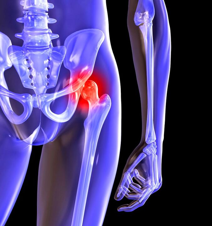 Verformung der Arthrose des Hüftgelenks
