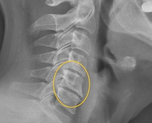 Osteochondrose der Halsspalte in einer X -Linie