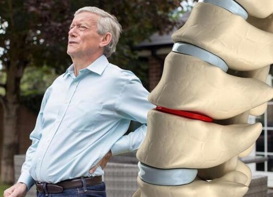 Osteochondrose betrifft die Bandscheiben und verursacht Rückenschmerzen.