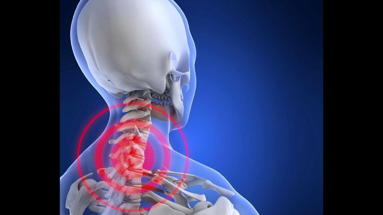 Osteochondrose der Halswirbelsäule.